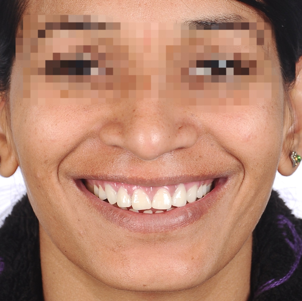 After Treatment - Bright White Smile